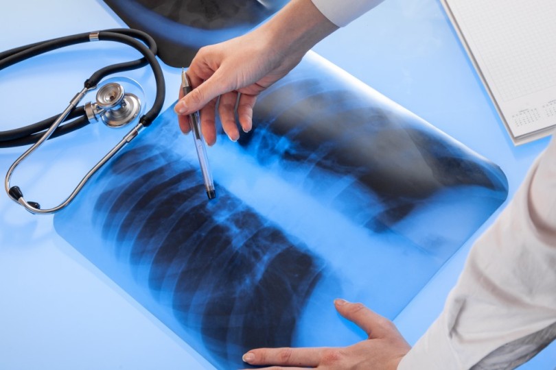 Lung Scan